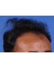 Before Hair Transplant&nbsp;Front